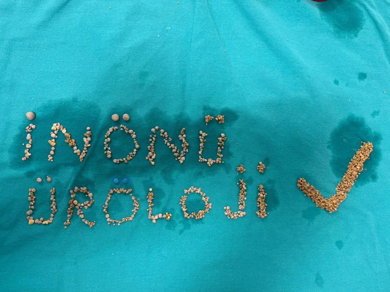 Ameliyattan hatıra: çıkan taşlarla imza attılar