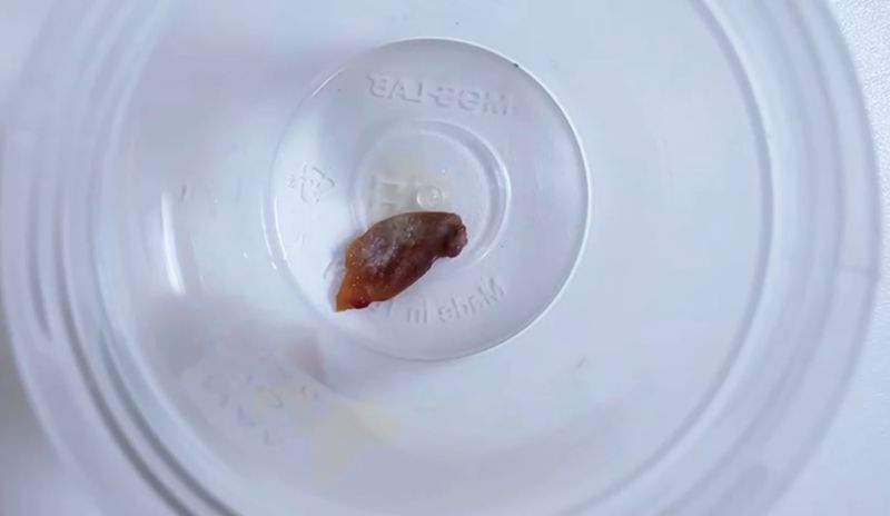 Bir Buçuk Yıllık Öksürüğün Sebebi Kabak Çekirdeği Çıktı