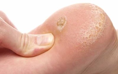 Uzman uyardı: Mantar enfeksiyonları yazın ayak araları ve kasıkta artıyor