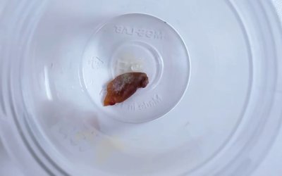 Bir Buçuk Yıllık Öksürüğün Sebebi Kabak Çekirdeği Çıktı