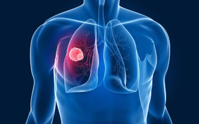 Göğüs Hast. Uzm. Dr. Tekeli: Kısa süreli kontroller akciğer kanserini erken teşhis ettiriyor