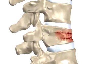 Omurga kırıkları kış aylarında artıyor